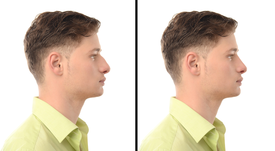 Life After Rhinoplasty - Ontario Canada Rhinoplasty