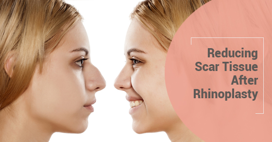 Reducing Scar Tissue After Rhinoplasty