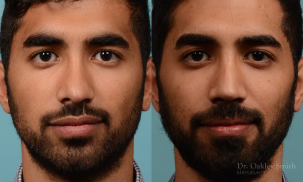 Male rhinoplasty to refine the nose