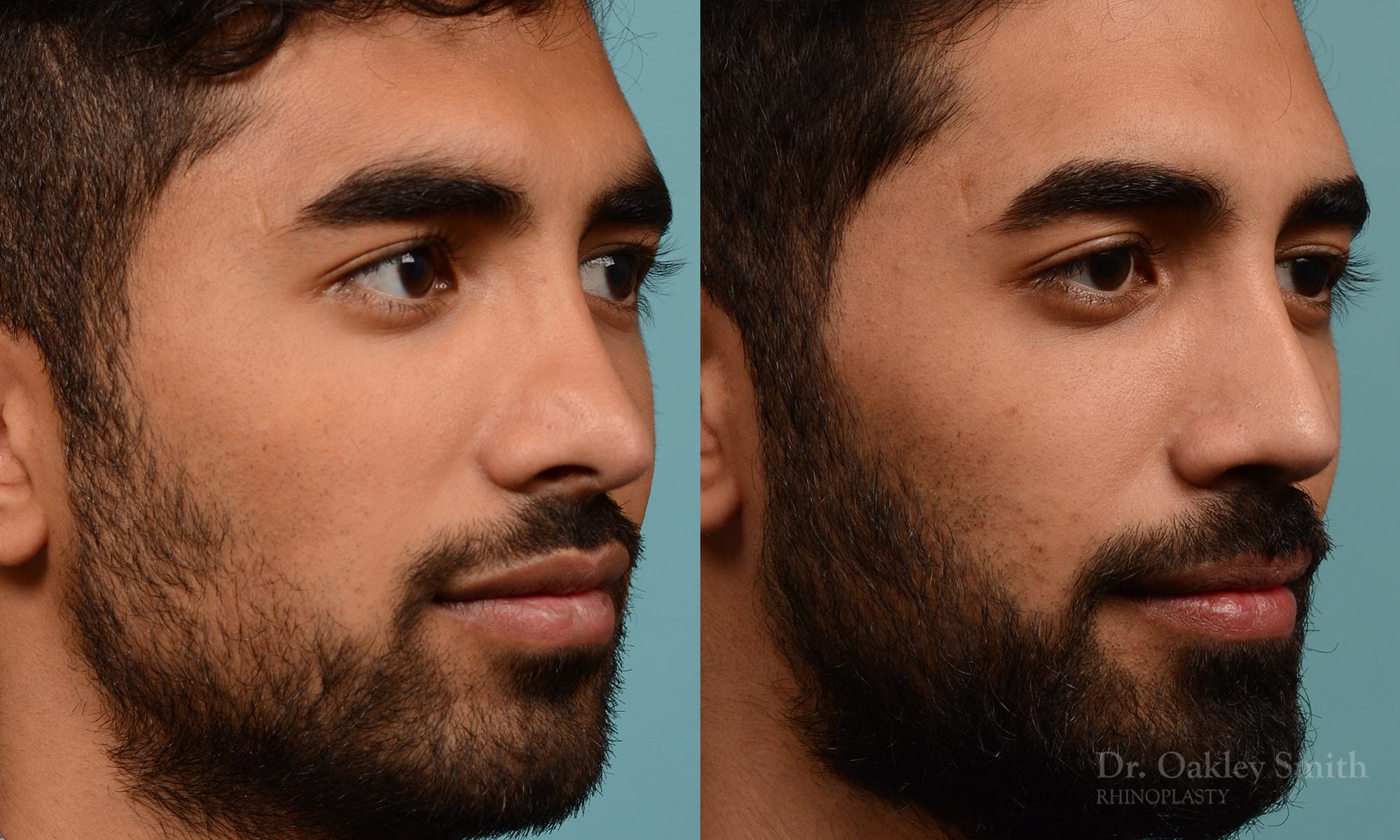 Male rhinoplasty to refine the nose