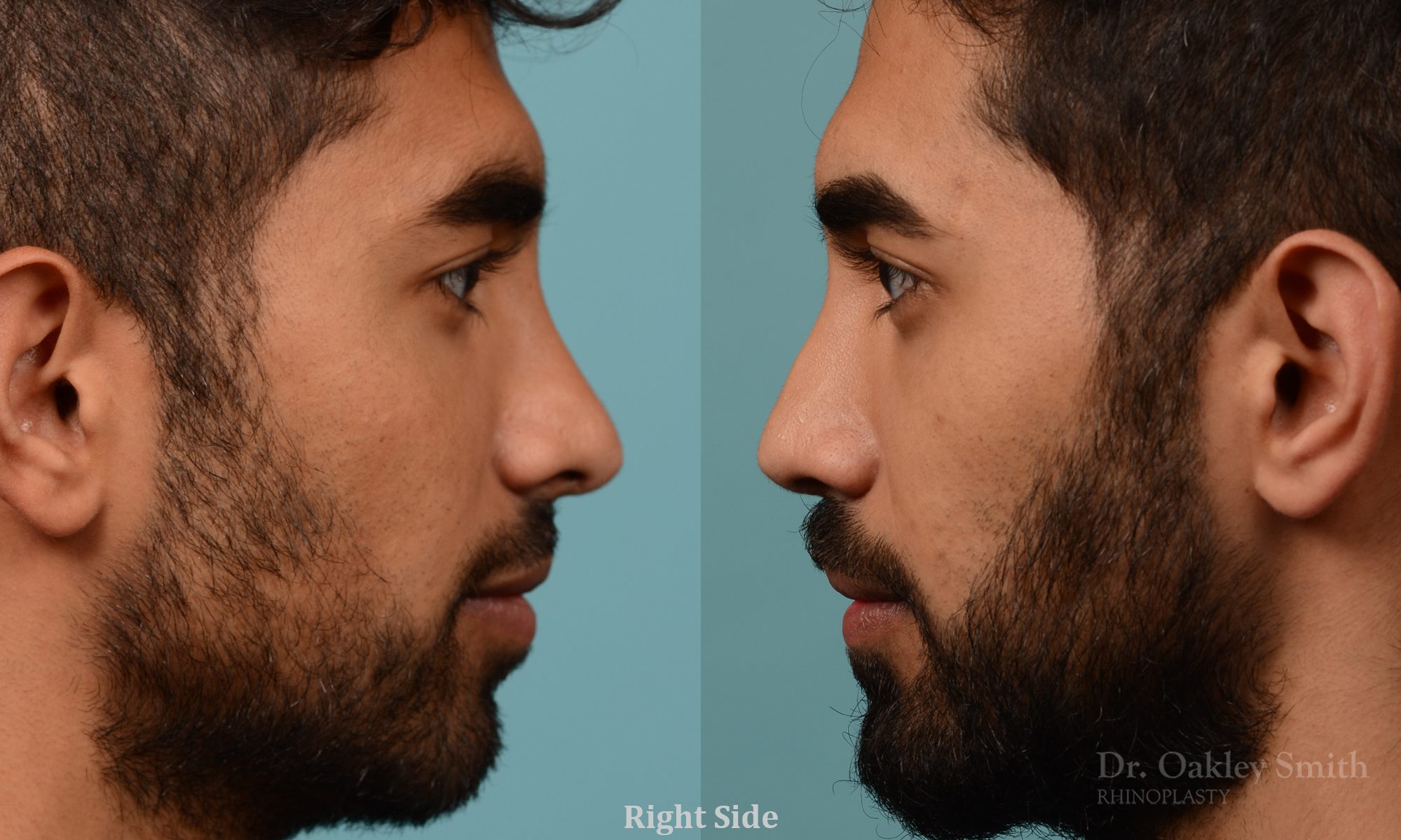 Male rhinoplasty to refine the nose