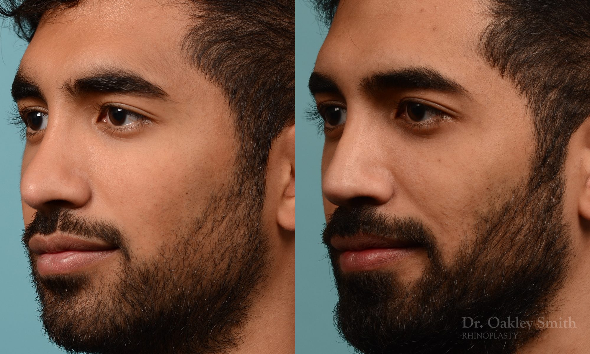 Male rhinoplasty to refine the nose