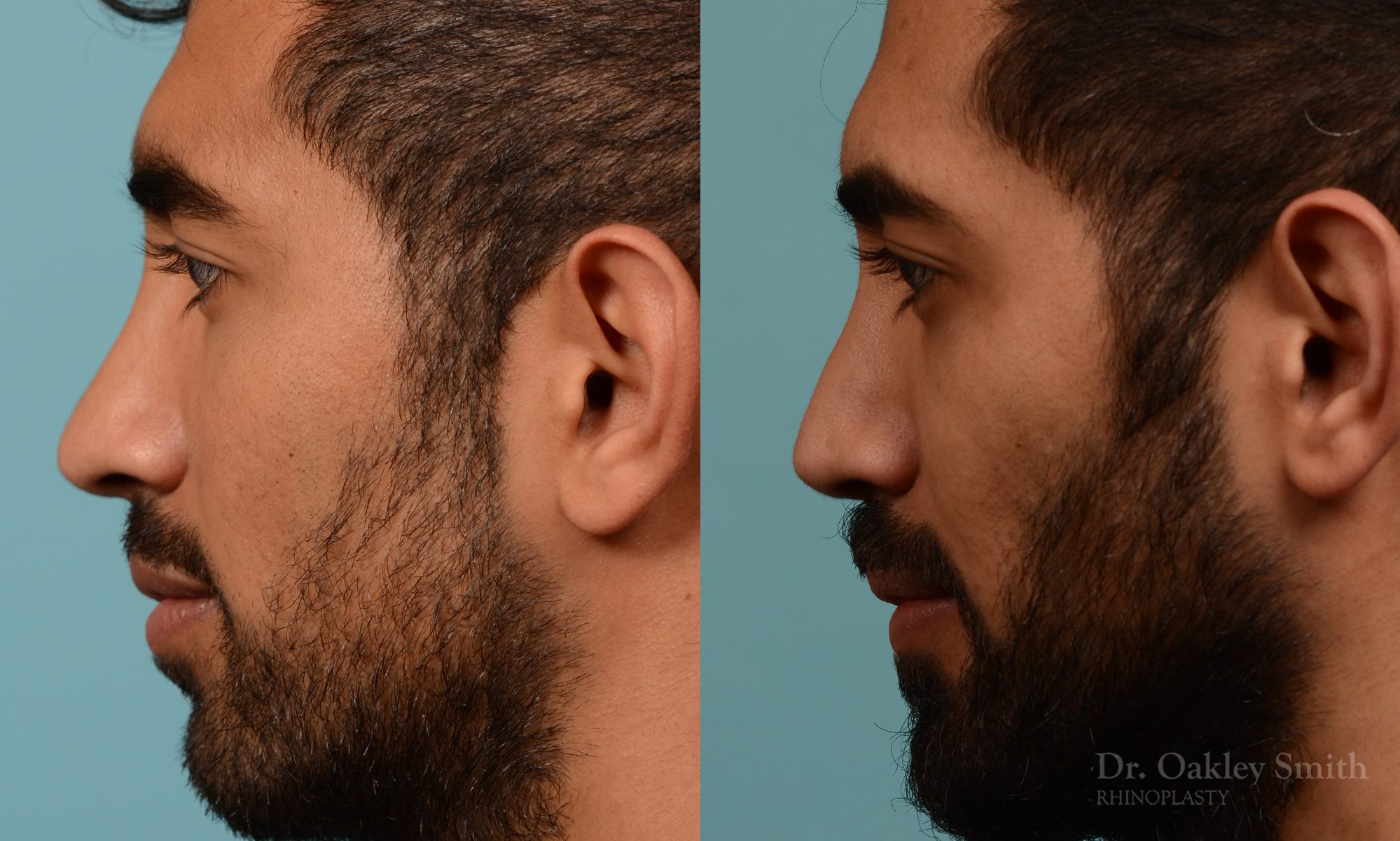 Male rhinoplasty to refine the nose