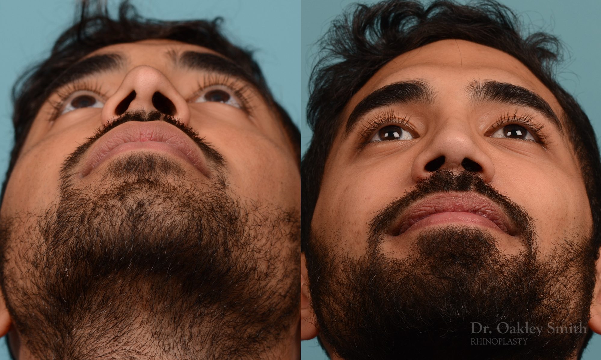 Male rhinoplasty to refine the nose