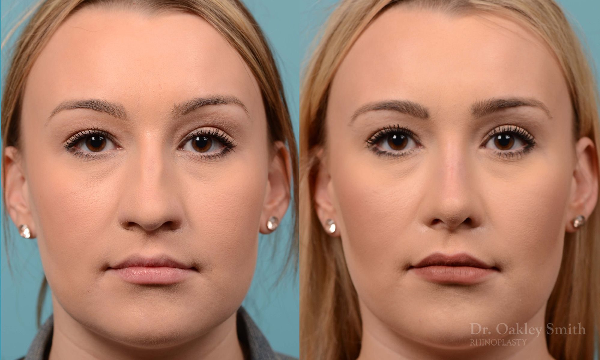 Rhinoplasty - Rhinoplasty Toronto Before and After Case 202