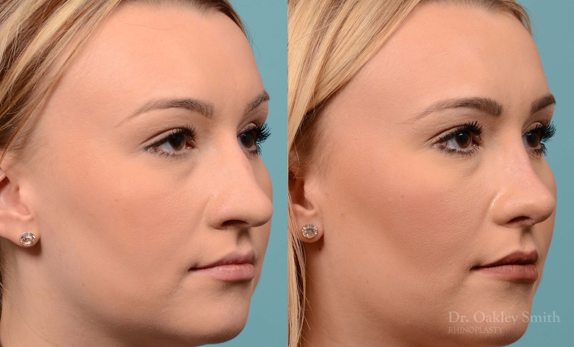 Rhinoplasty - Rhinoplasty Toronto Before and After Case 202