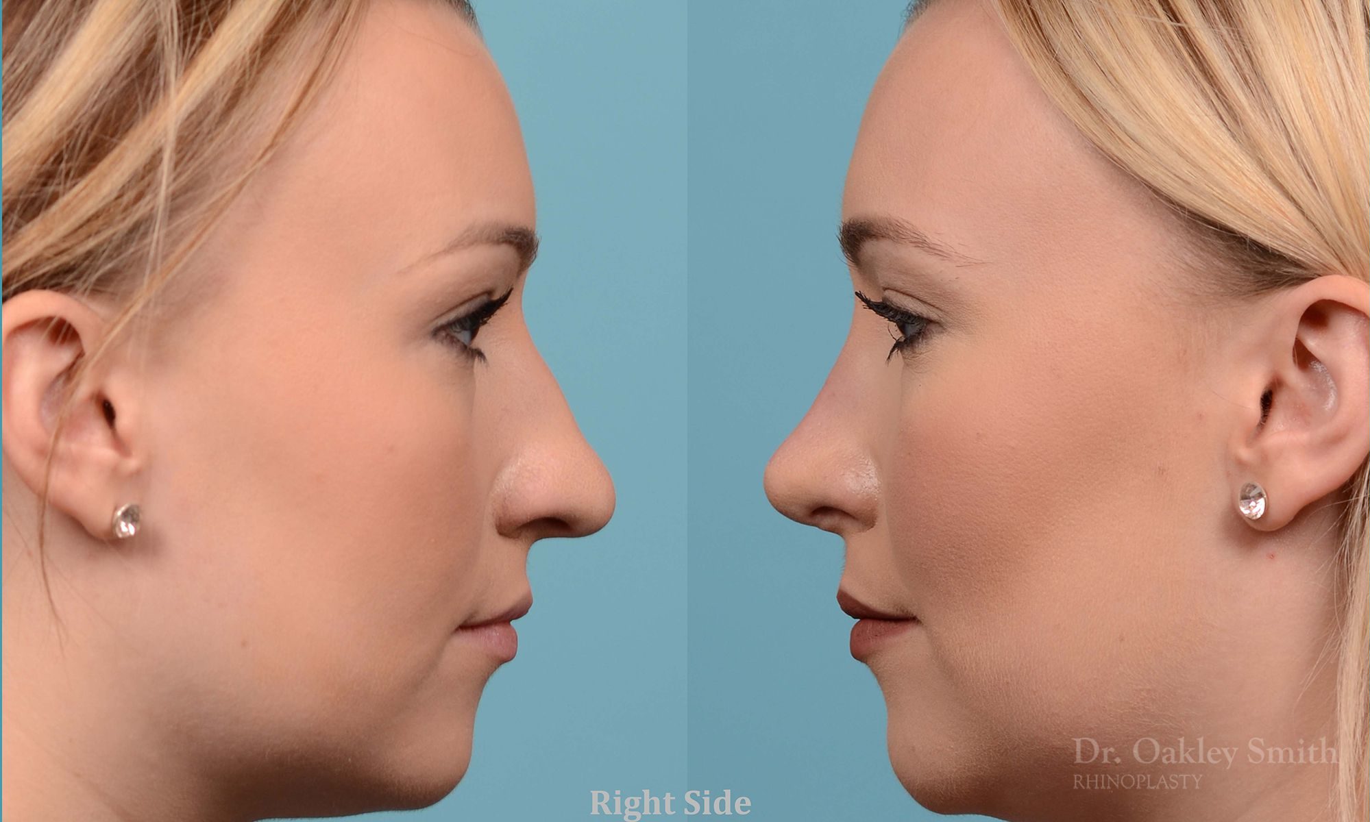 Rhinoplasty - Rhinoplasty Toronto Before and After Case 202