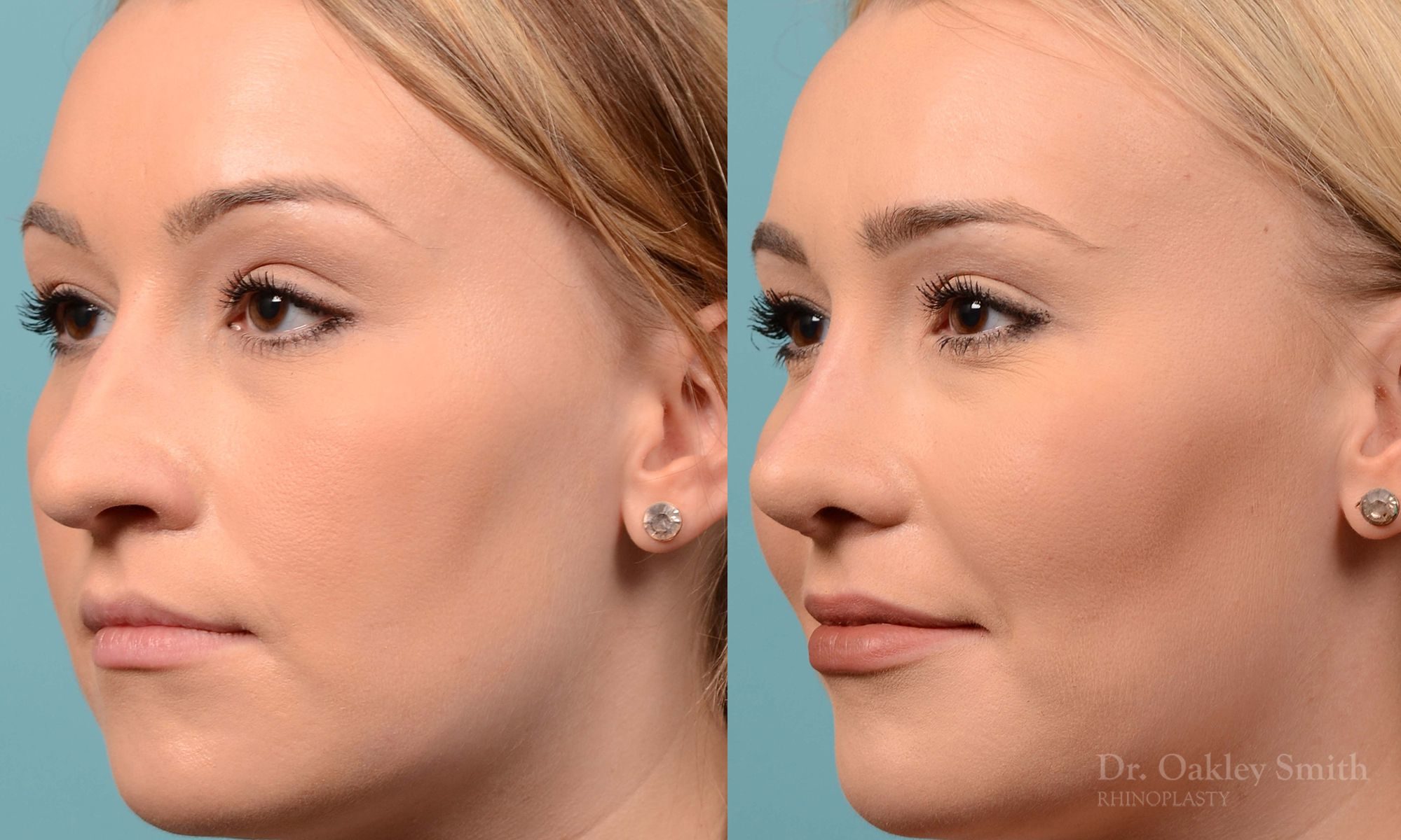 Rhinoplasty - Rhinoplasty Toronto Before and After Case 202