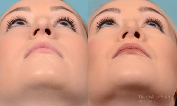 Rhinoplasty - Rhinoplasty Toronto Before and After Case 202