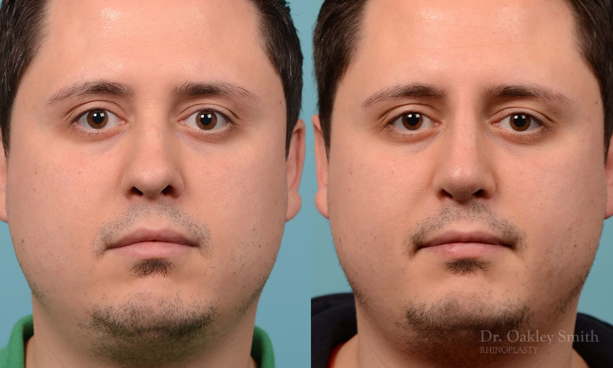 Revision Rhinoplasty, Rhinoplasty - Rhinoplasty Toronto Hump Reduction Case 203