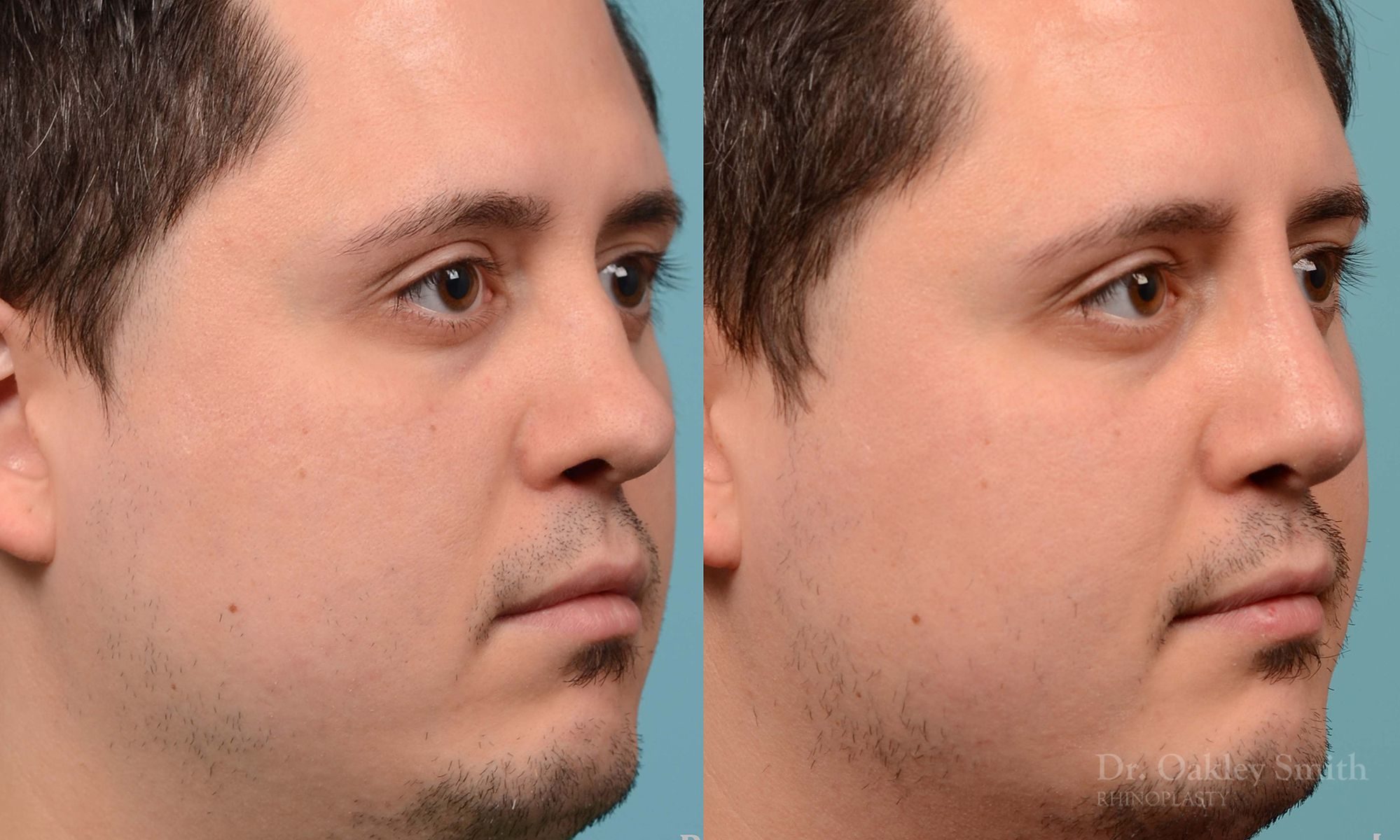 Revision Rhinoplasty, Rhinoplasty - Rhinoplasty Toronto Hump Reduction Case 203