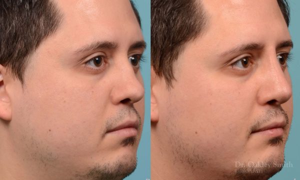 Revision Rhinoplasty, Rhinoplasty - Rhinoplasty Toronto Hump Reduction Case 203