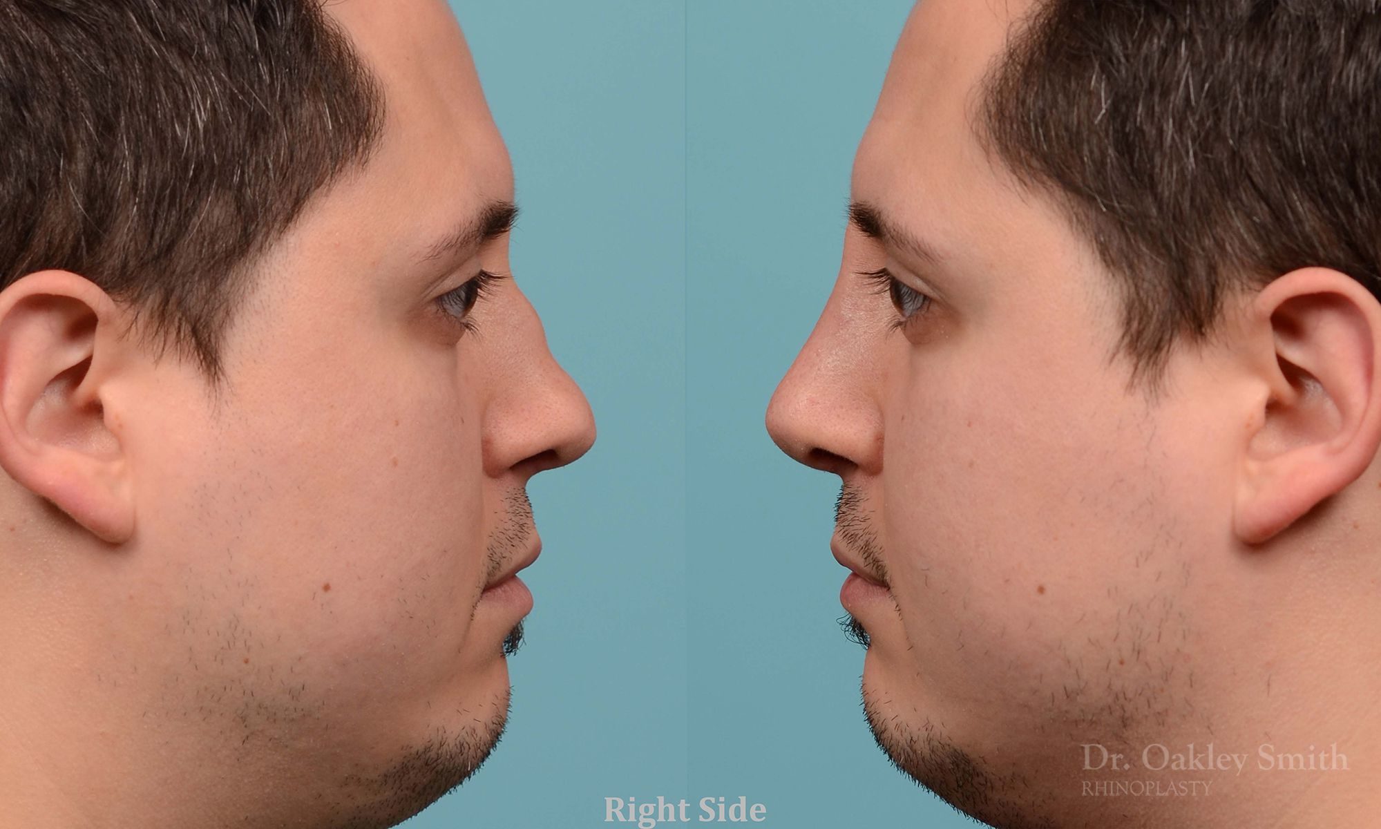 Revision Rhinoplasty, Rhinoplasty - Rhinoplasty Toronto Hump Reduction Case 203