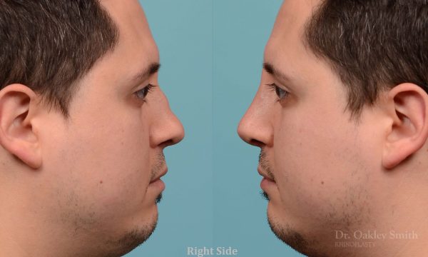 Revision Rhinoplasty, Rhinoplasty - Rhinoplasty Toronto Hump Reduction Case 203