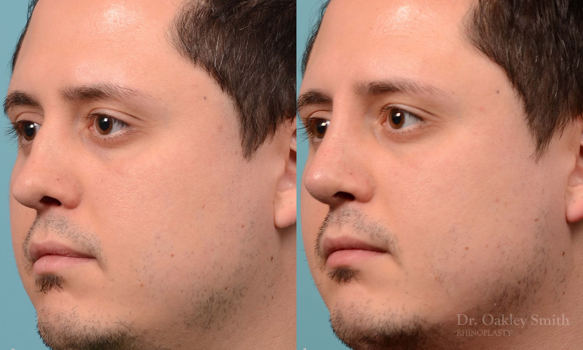 Revision Rhinoplasty, Rhinoplasty - Rhinoplasty Toronto Hump Reduction Case 203