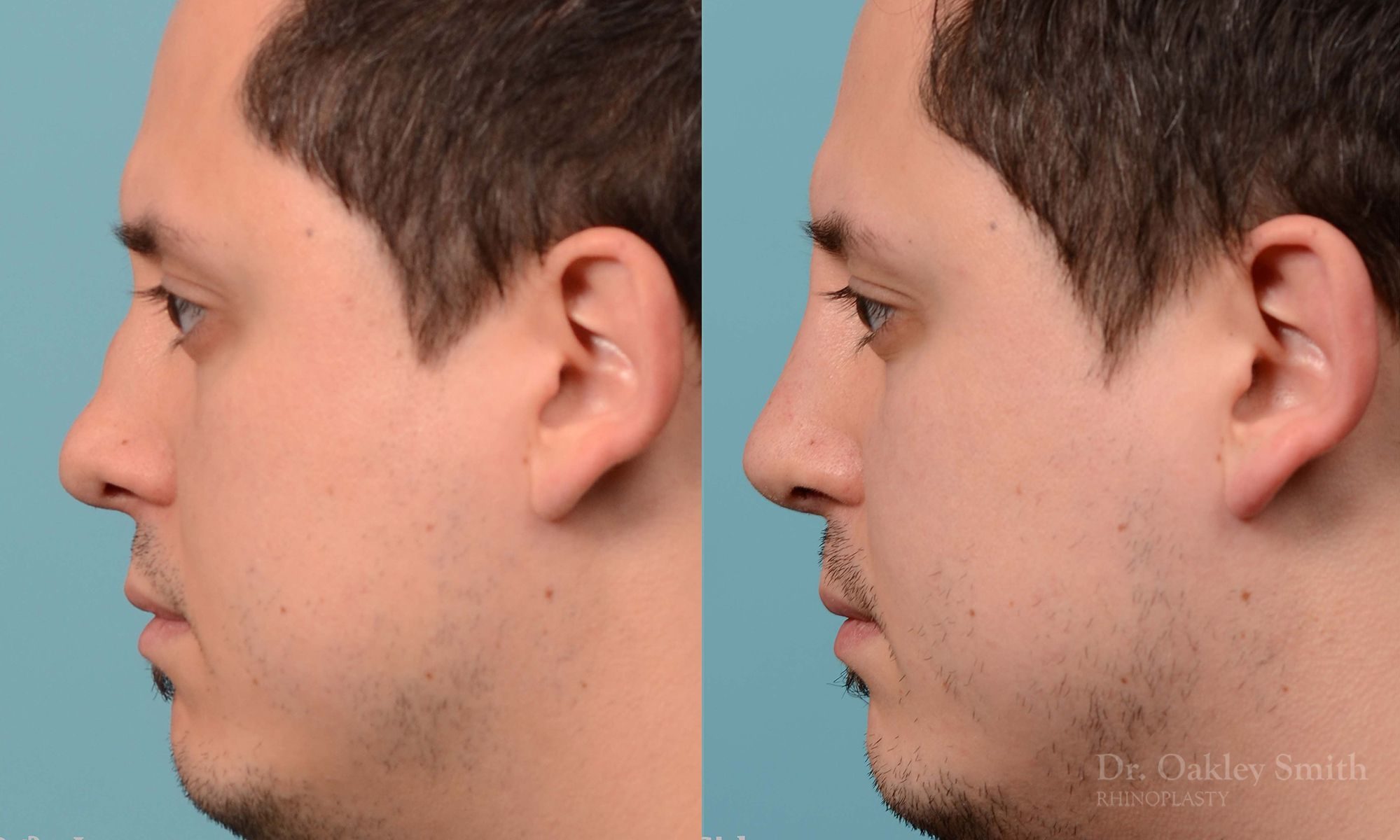Revision Rhinoplasty, Rhinoplasty - Rhinoplasty Toronto Hump Reduction Case 203