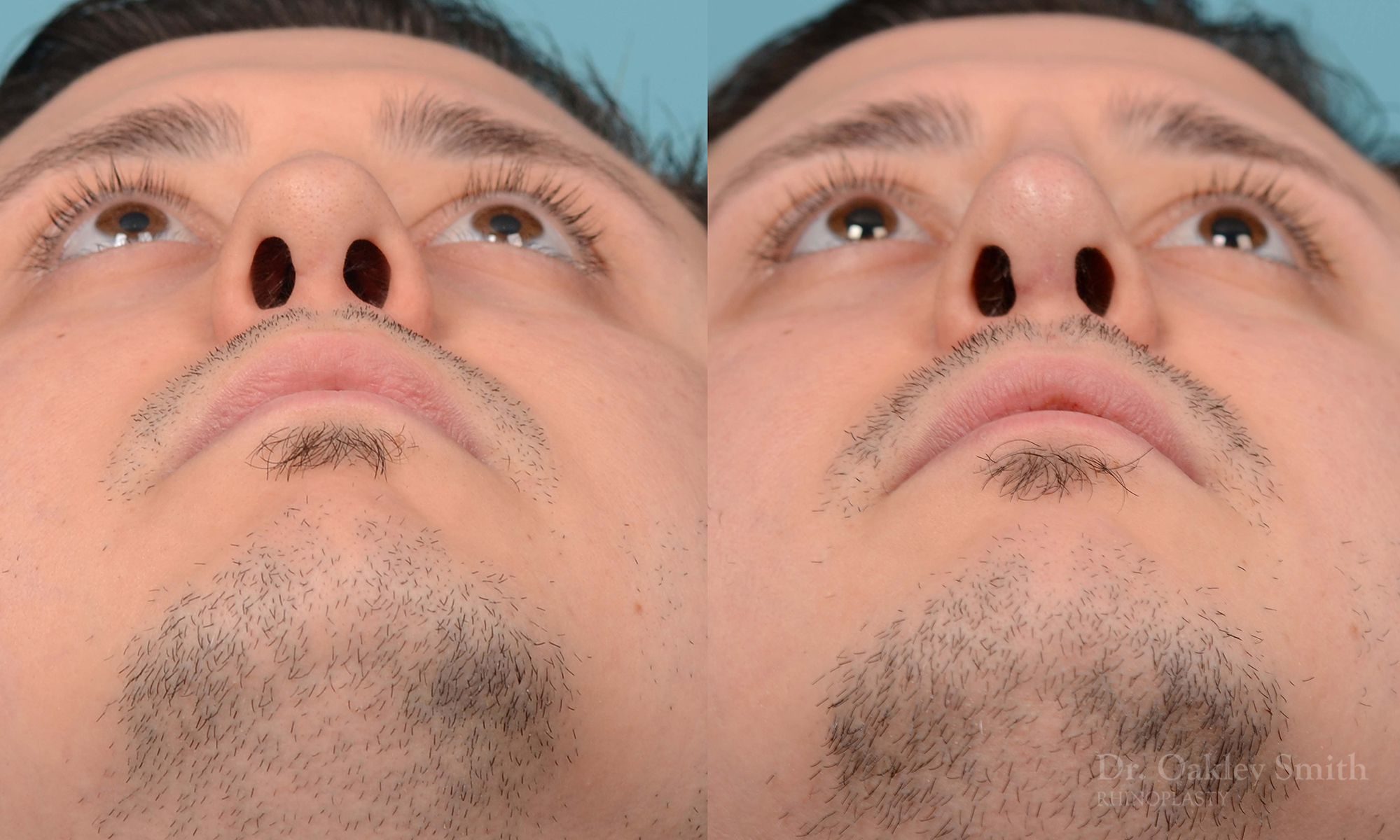 Revision Rhinoplasty, Rhinoplasty - Rhinoplasty Toronto Hump Reduction Case 203