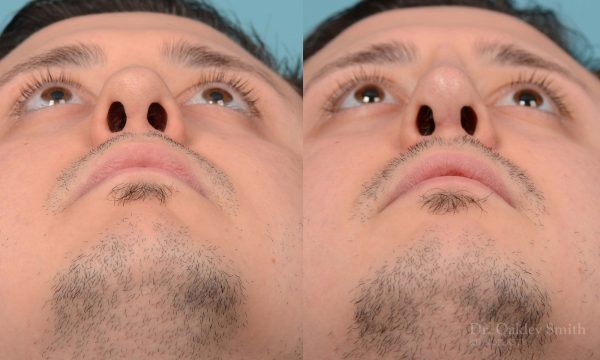 Revision Rhinoplasty, Rhinoplasty - Rhinoplasty Toronto Hump Reduction Case 203