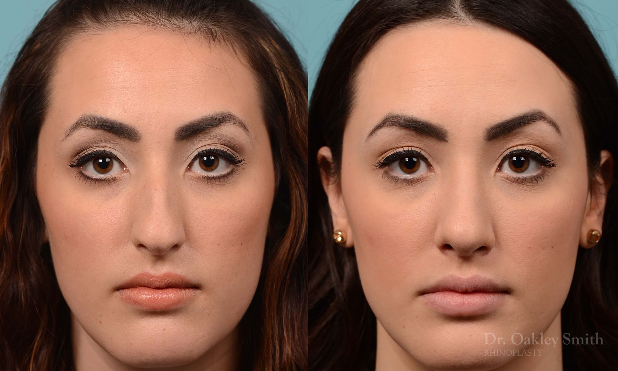 Bump removal rhinoplasty on female