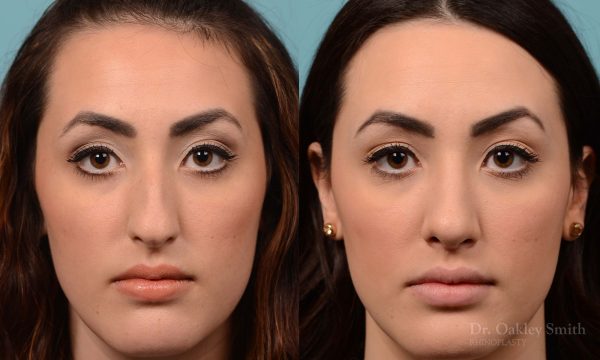 Bump removal rhinoplasty on female