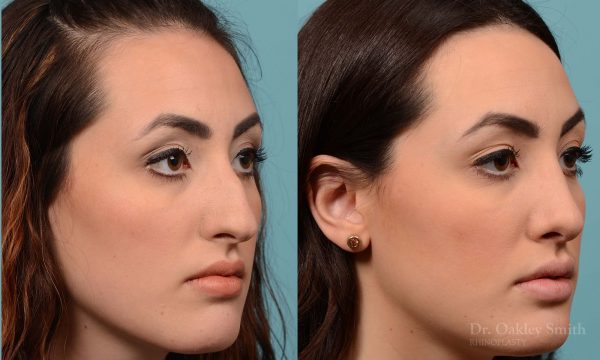 Bump removal rhinoplasty on female