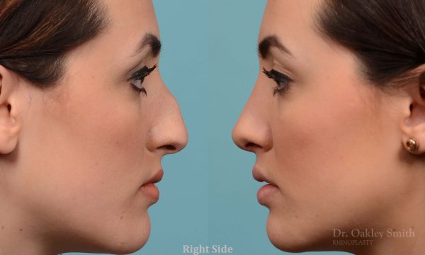 Bump removal rhinoplasty on female