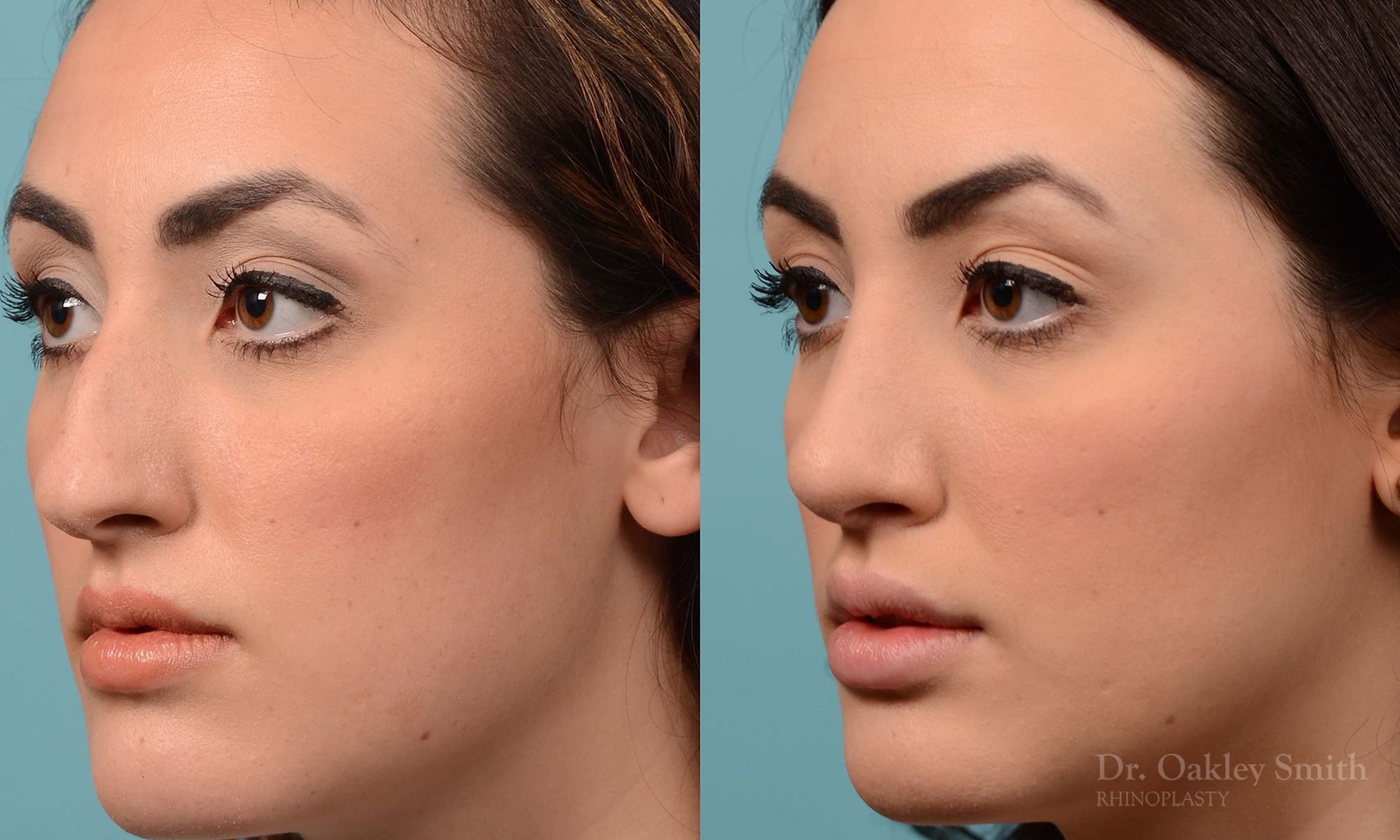 Bump removal rhinoplasty on female