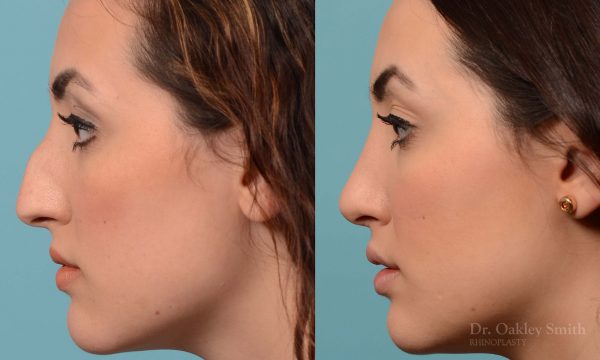 Bump removal rhinoplasty on female