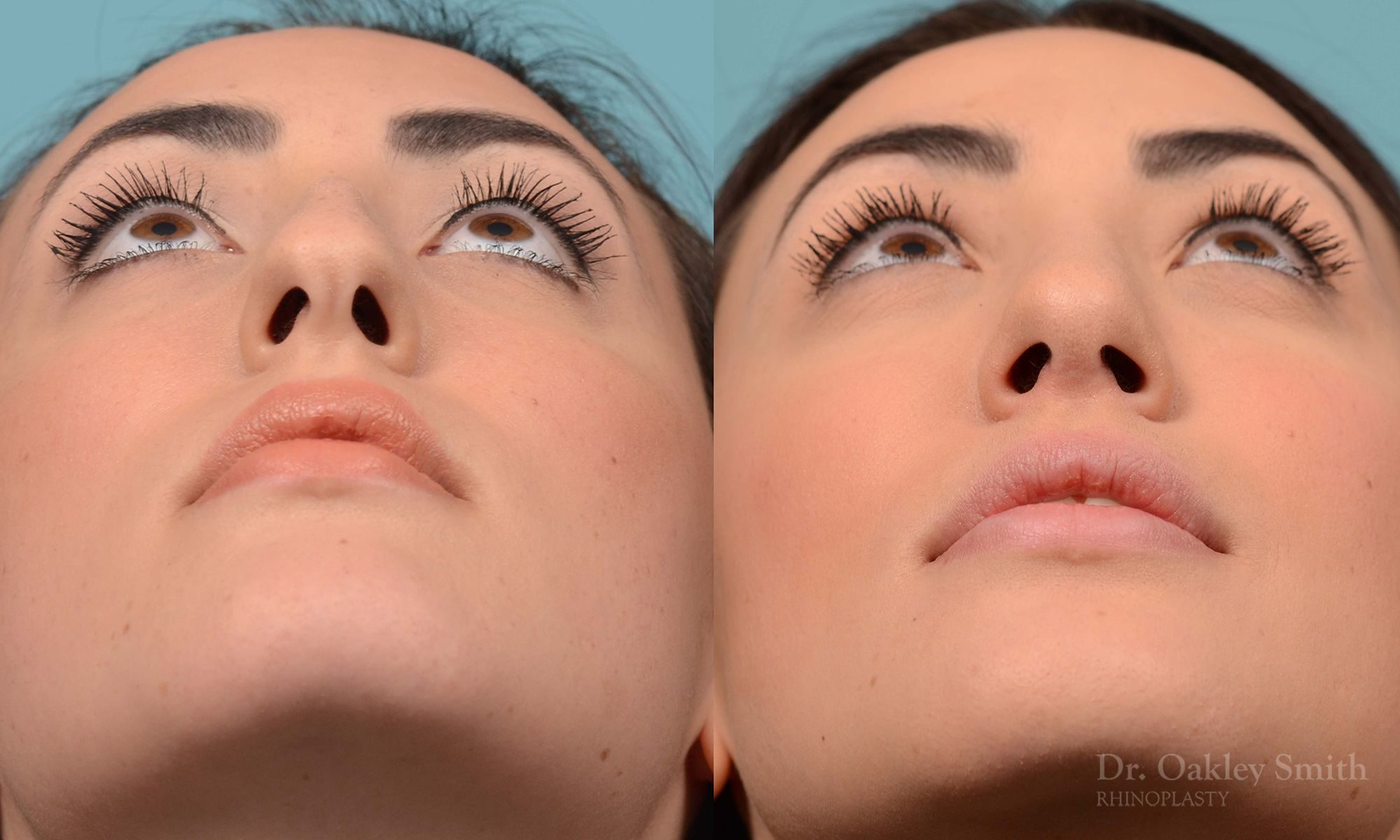 Bump removal rhinoplasty on female