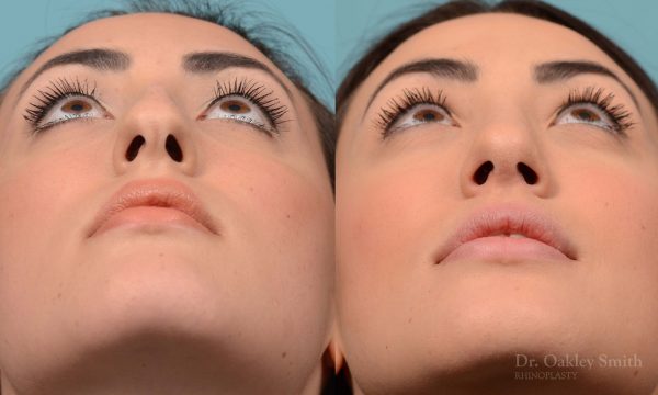 Bump removal rhinoplasty on female