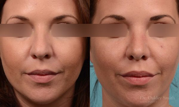 female rhinoplasty and hump reduction