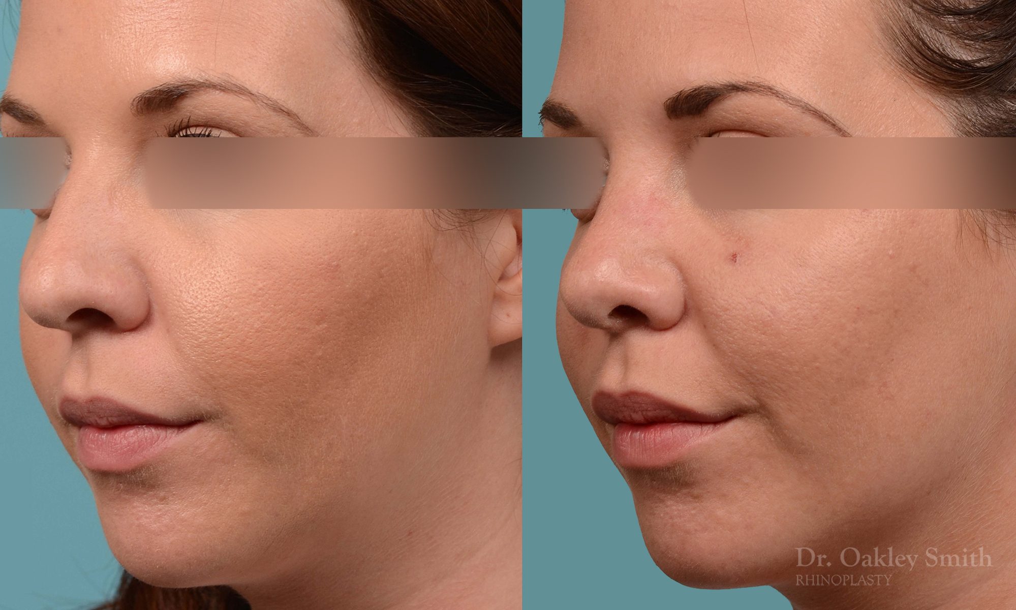 female rhinoplasty and hump reduction
