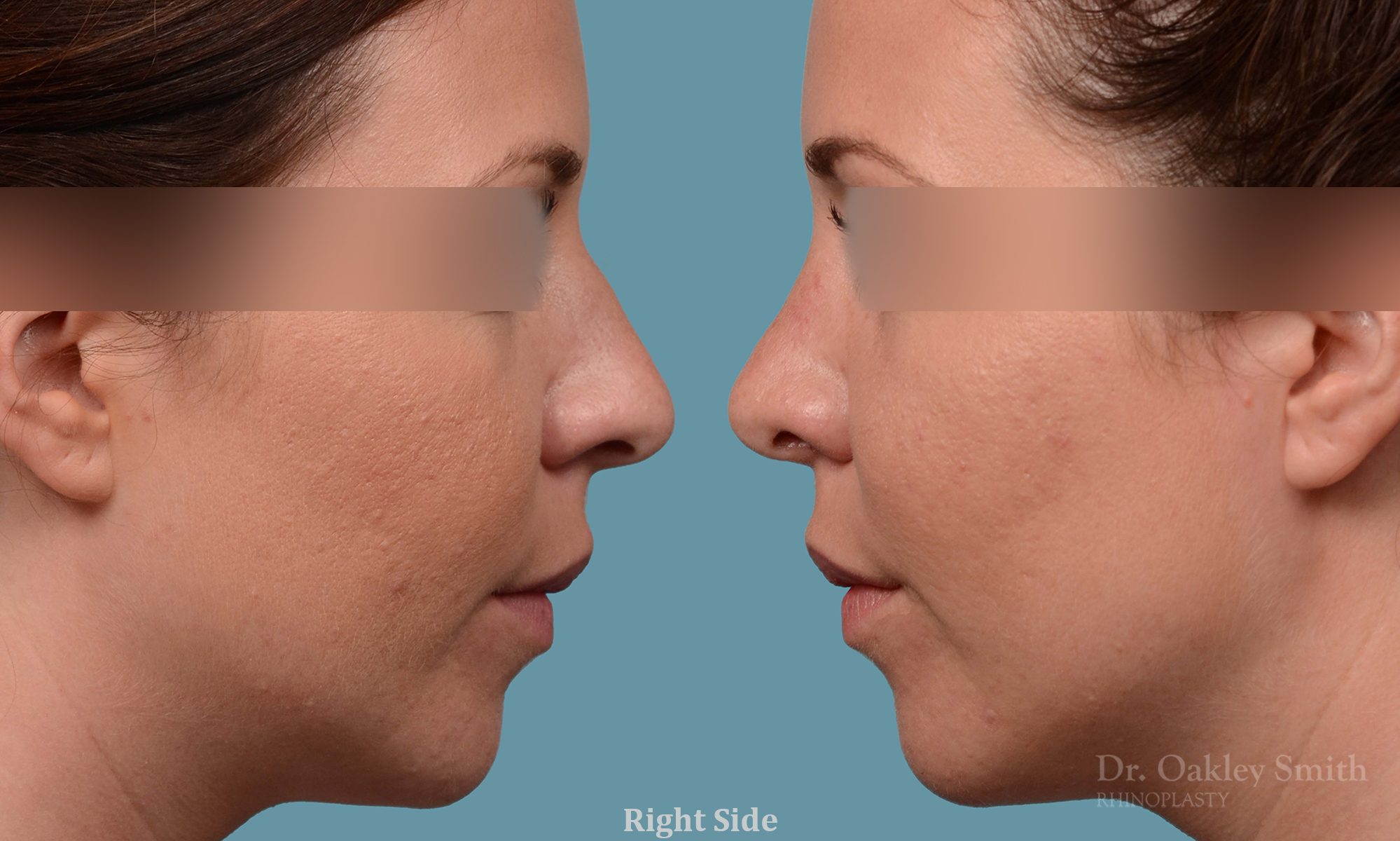 female rhinoplasty and hump reduction