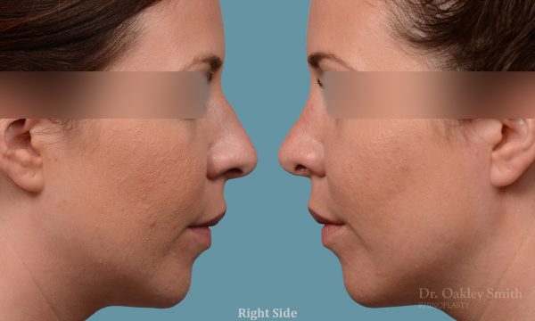 female rhinoplasty and hump reduction