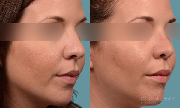female rhinoplasty and hump reduction