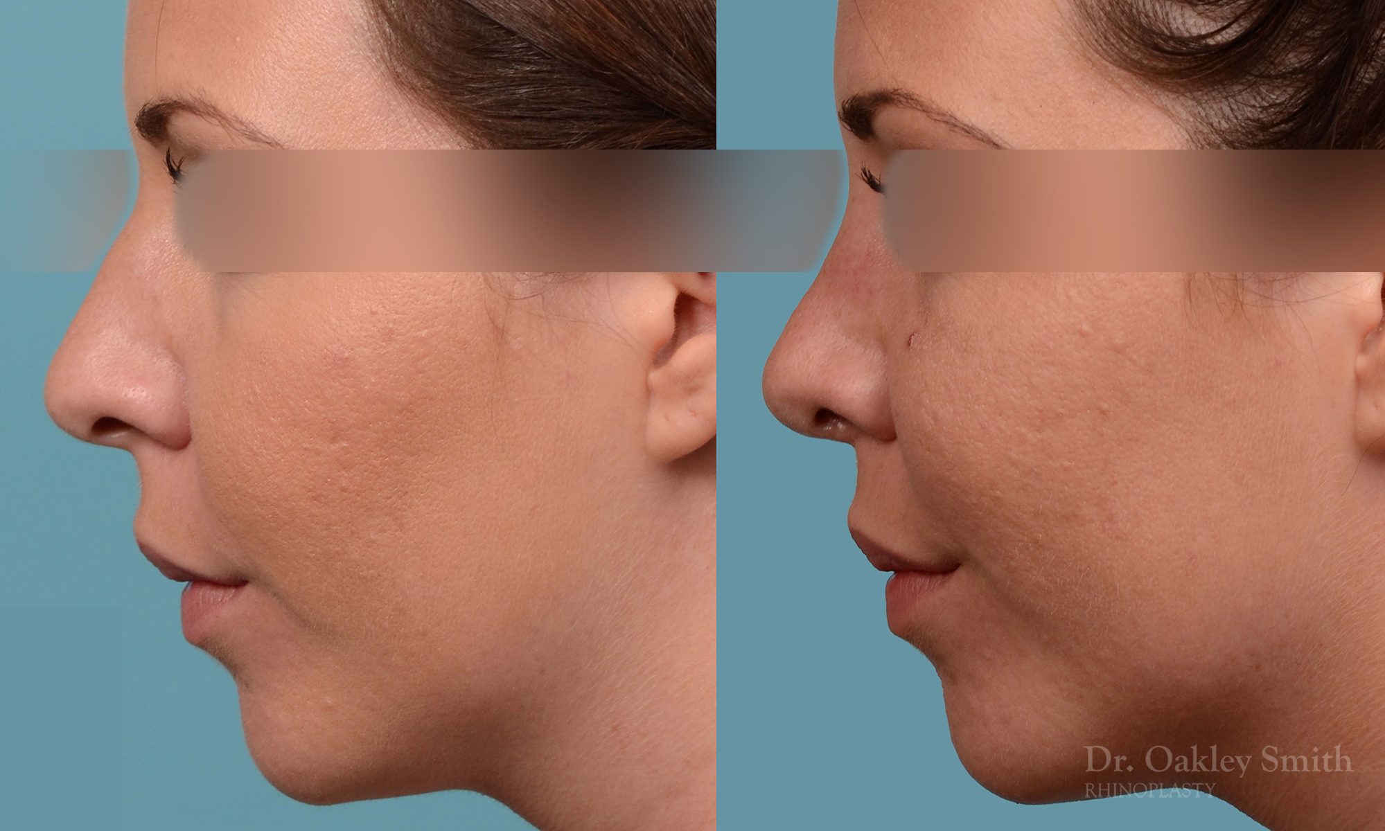 female rhinoplasty and hump reduction
