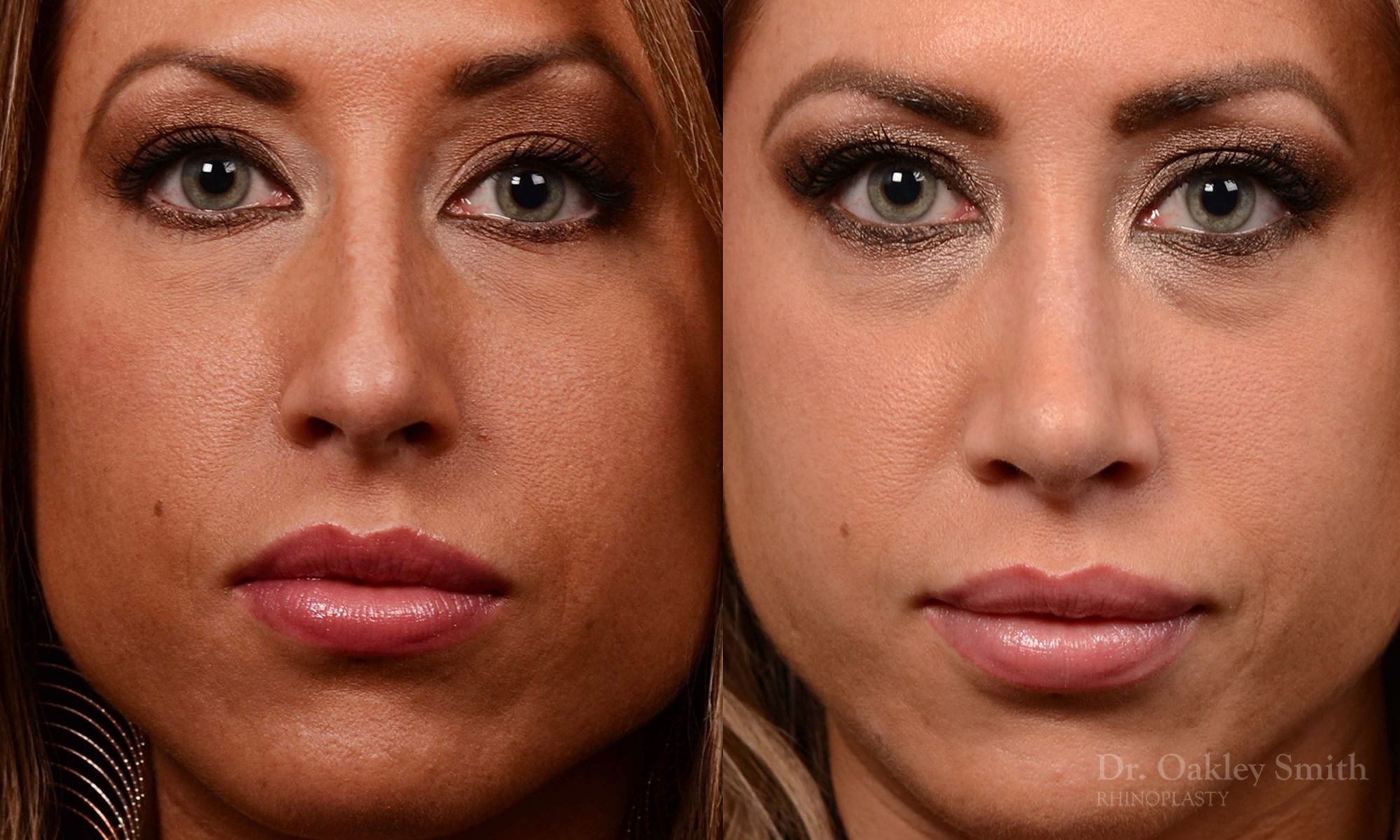 nose surgery for hump reduction
