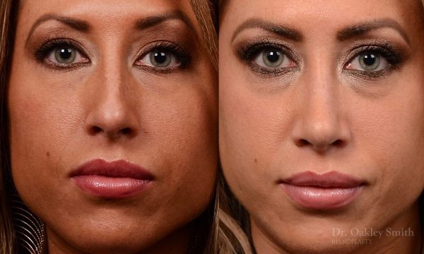 nose surgery for hump reduction