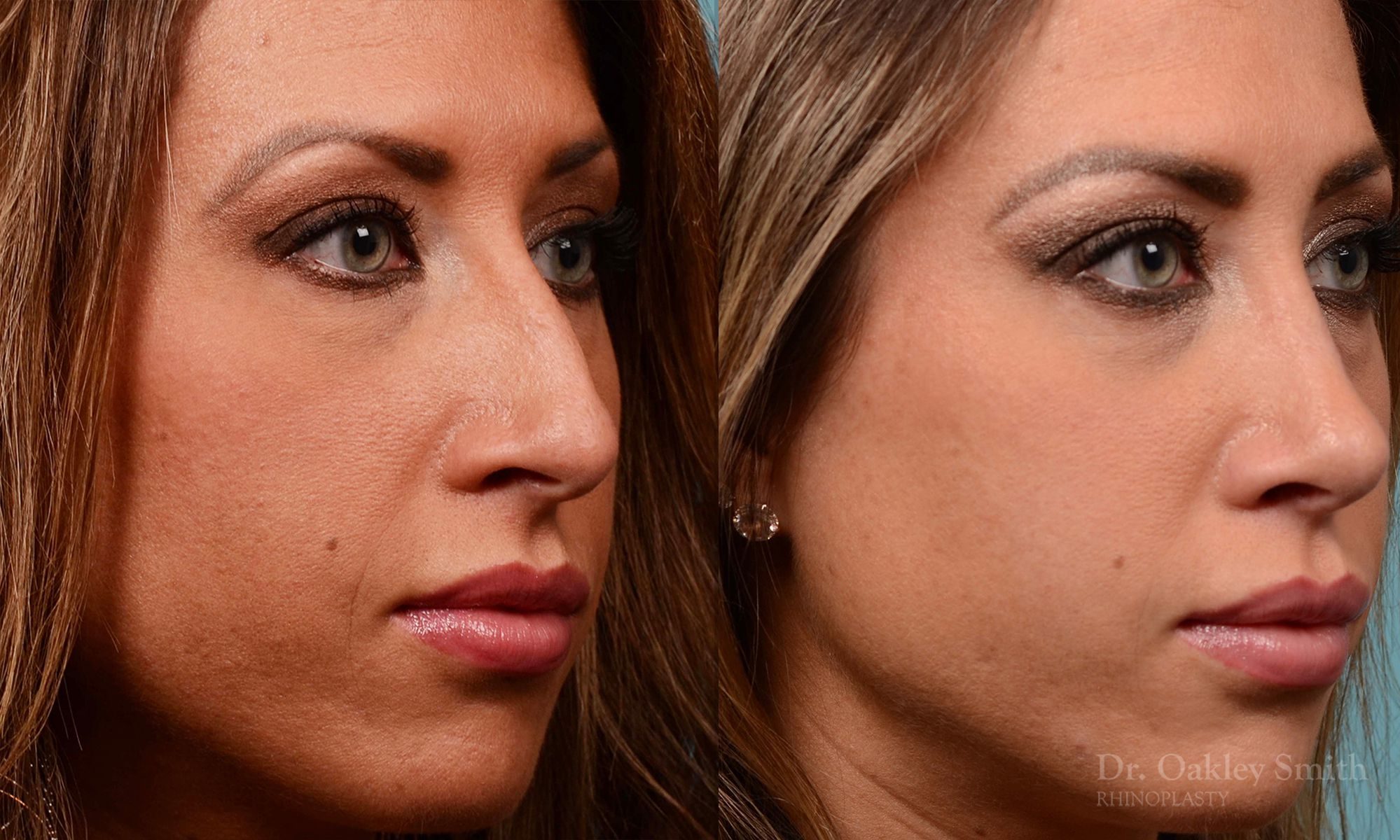 Rhinoplasty - Rhinoplasty Nose Surgery Before After Case 208