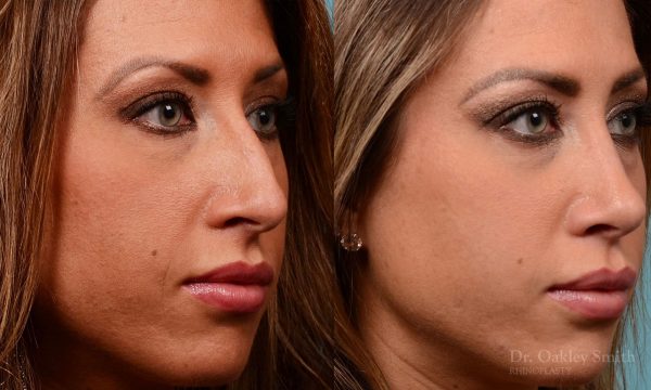 Rhinoplasty - Rhinoplasty Nose Surgery Before After Case 208