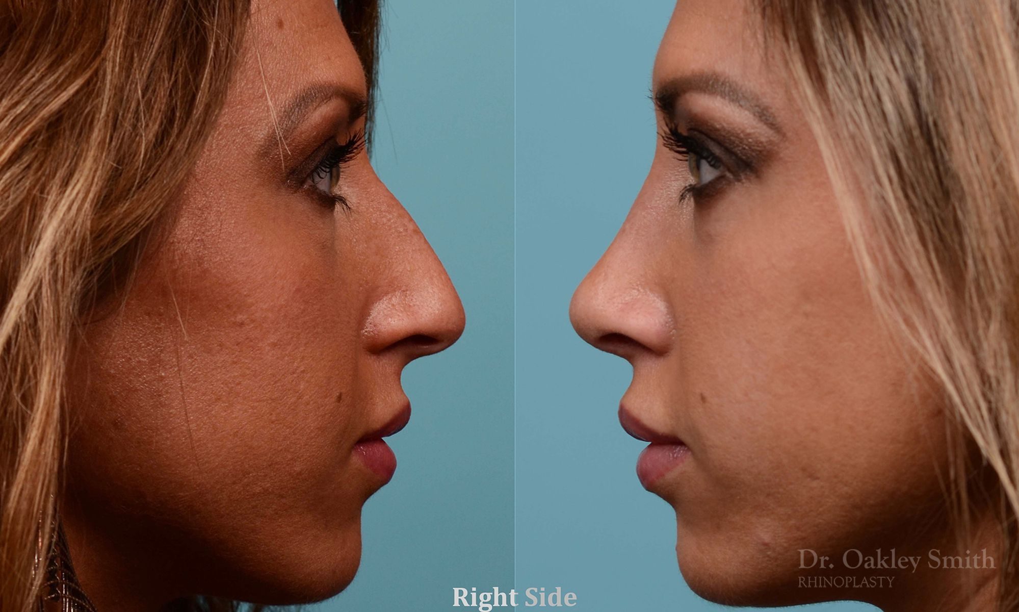 Nose surgery for hump reduction