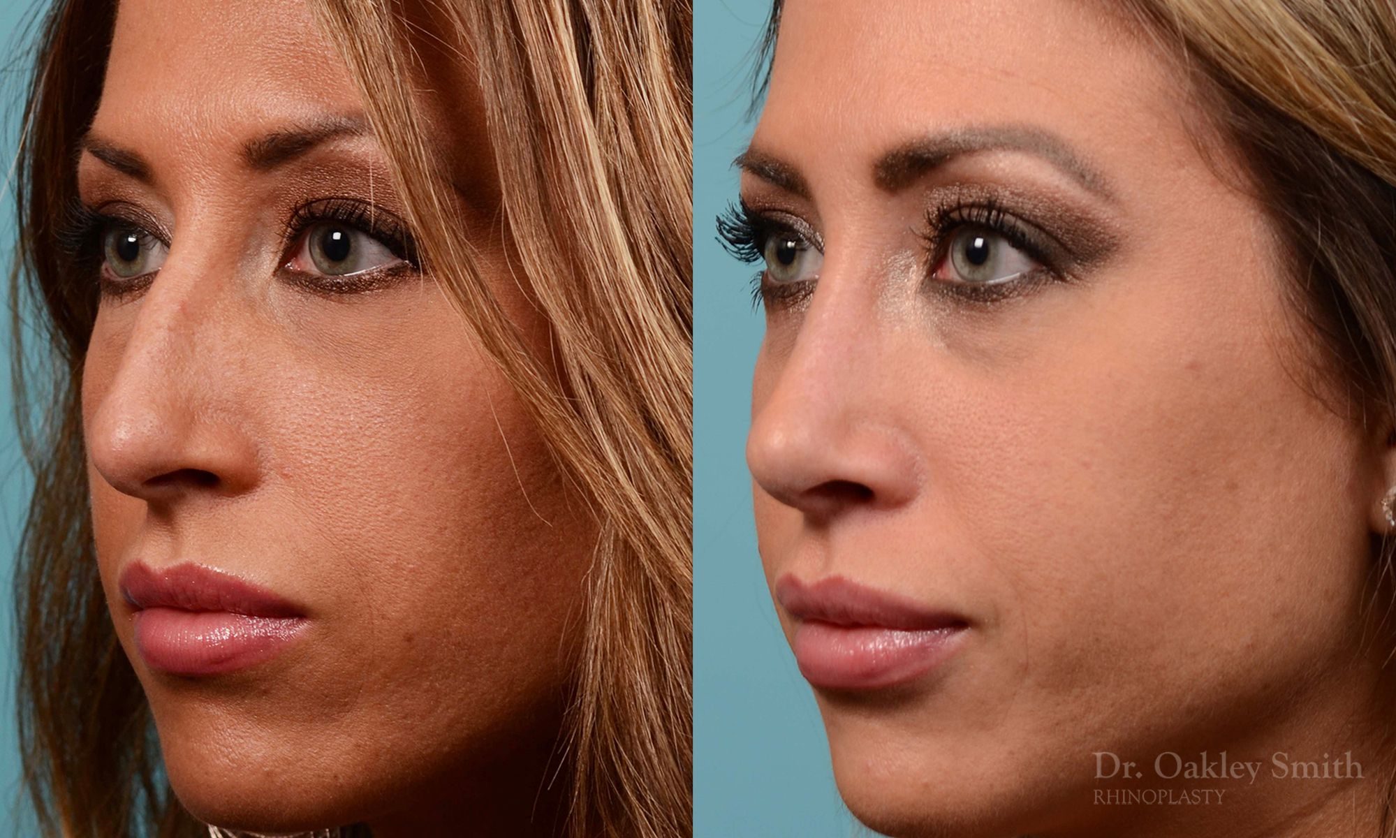 Nose surgery for hump reduction