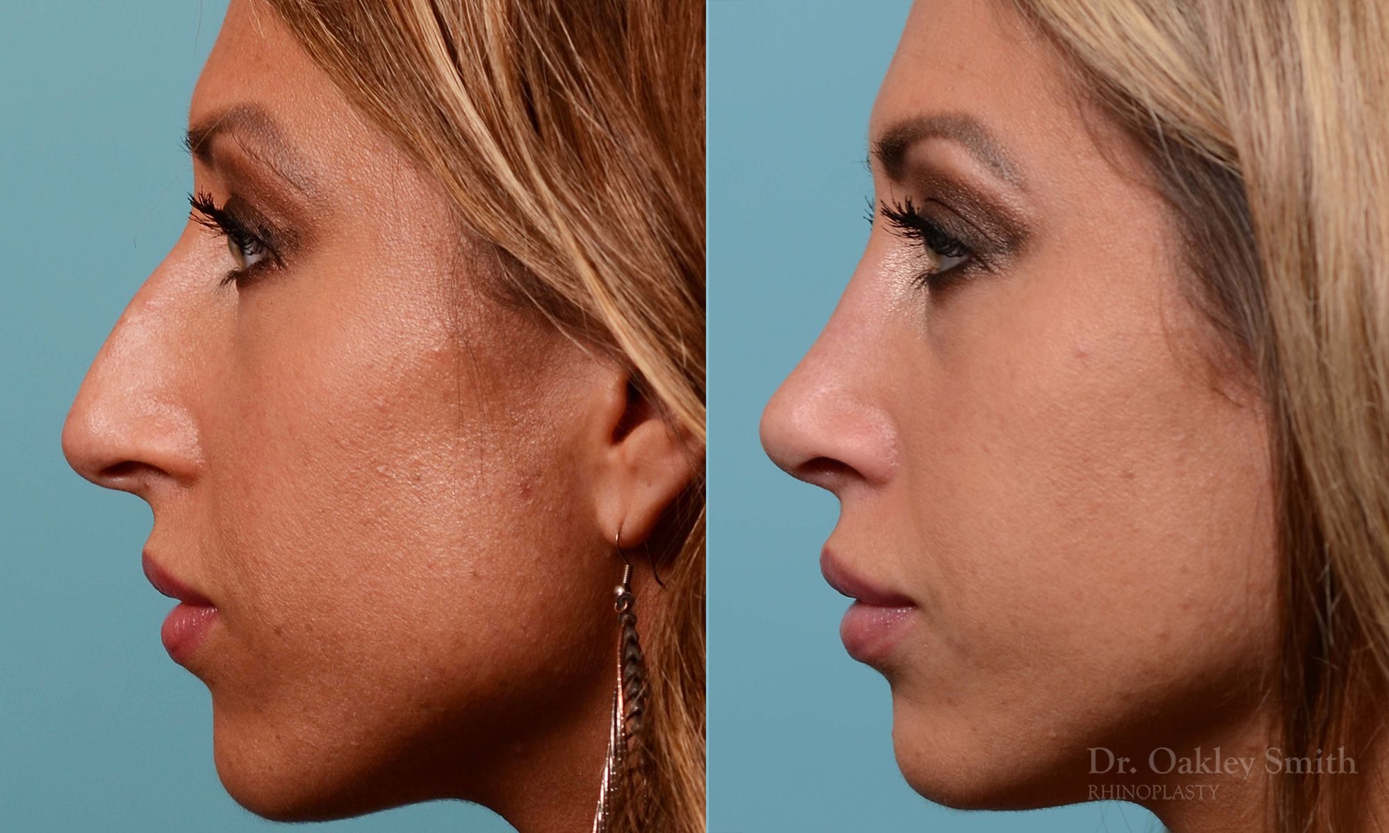 nose surgery for hump reduction
