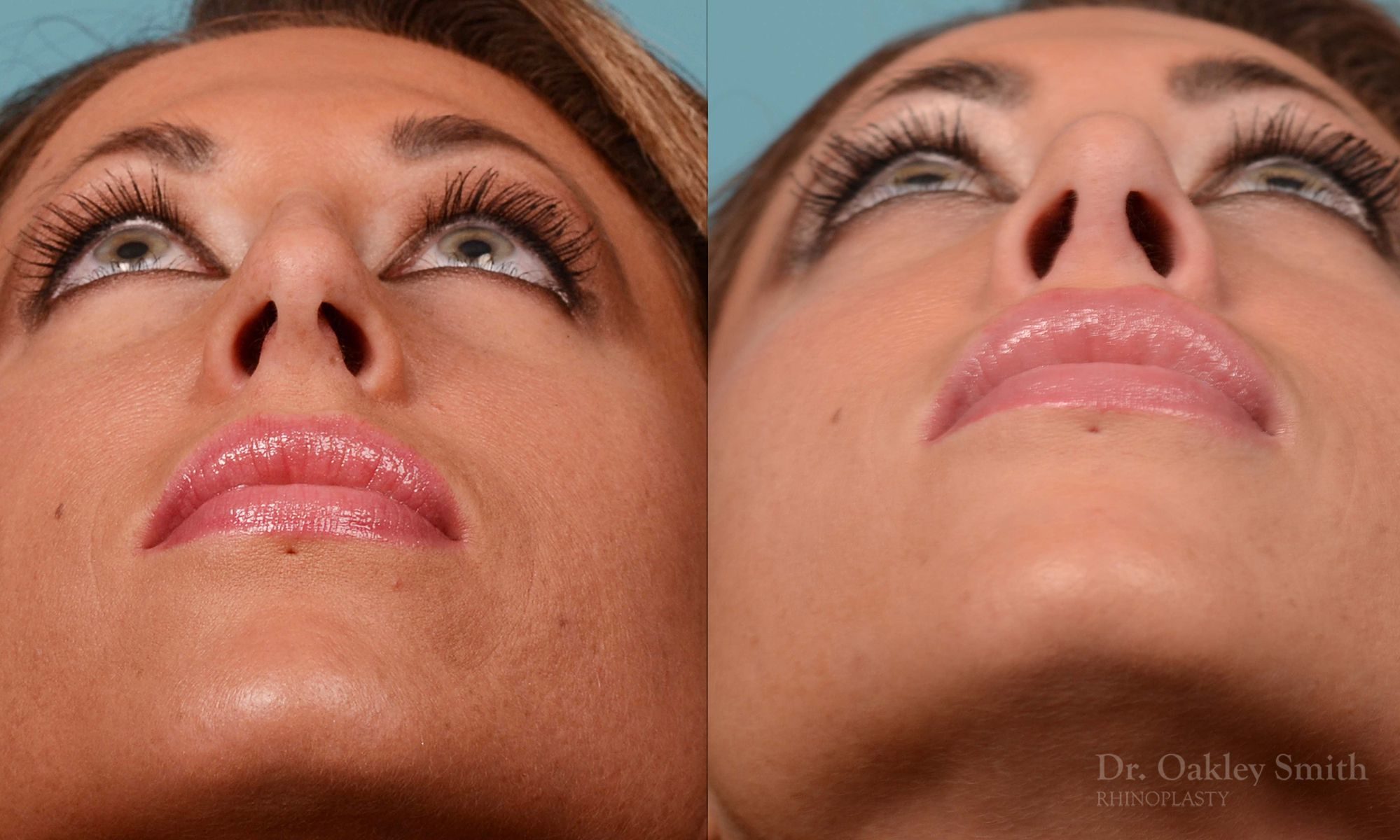 Nose Surgery Rhinoplasty Ontario Dr 