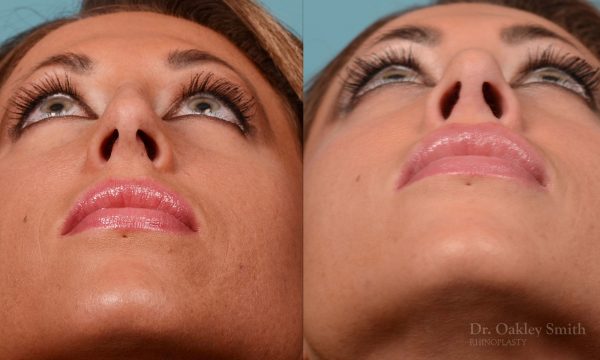 nose surgery for hump reduction