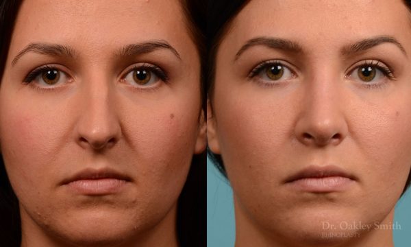 Rhinoplasty hump reduction surgery