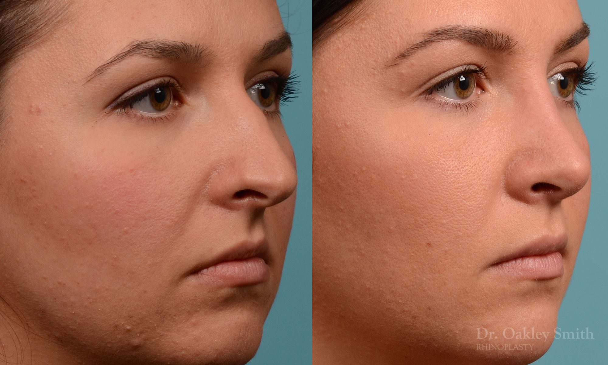 Rhinoplasty hump reduction