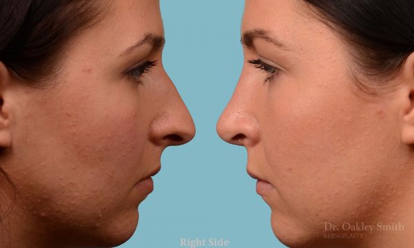 Rhinoplasty hump reduction