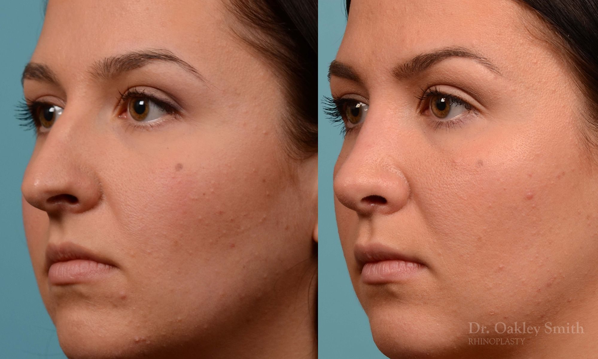 Rhinopasty hump reduction