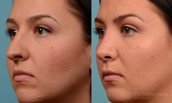 Rhinopasty hump reduction
